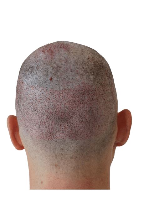 Diagram dat het donorgebied op het hoofd aangeeft