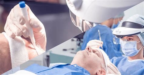 Vergelijking van verschillende haartransplantatietechnieken