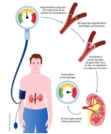 Visuele weergave van de impact van hoge bloeddruk op organen.